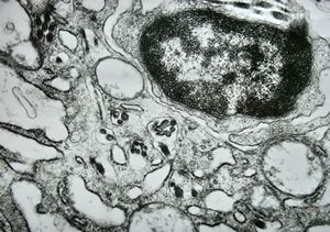 M, 40y. | unclassified skin inflammation … phagocytosed of collagen M, 40y. | unclassified skin inflammation … phagocytosed of collagen